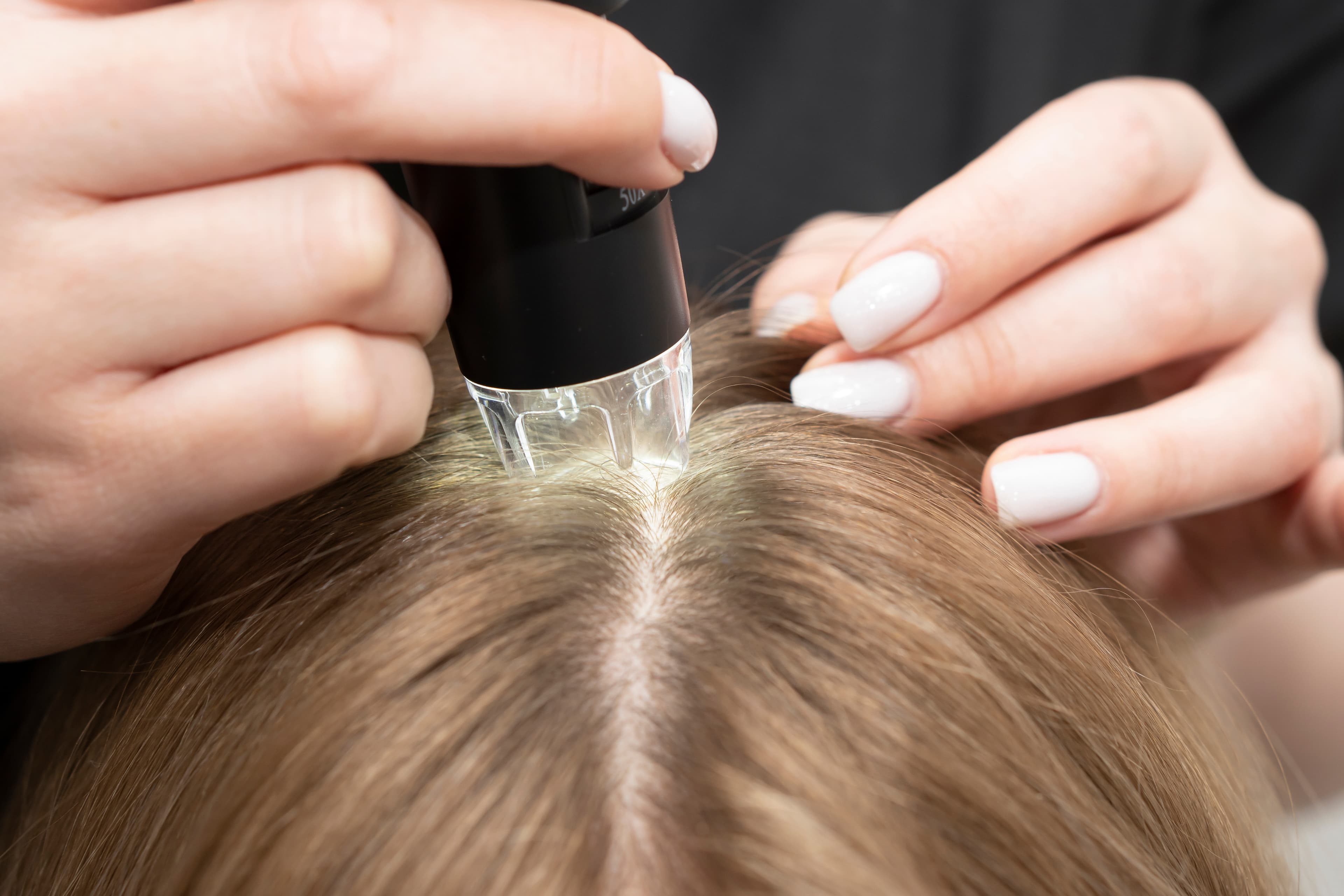 Diagnóstico e Tratamento de Alopecias